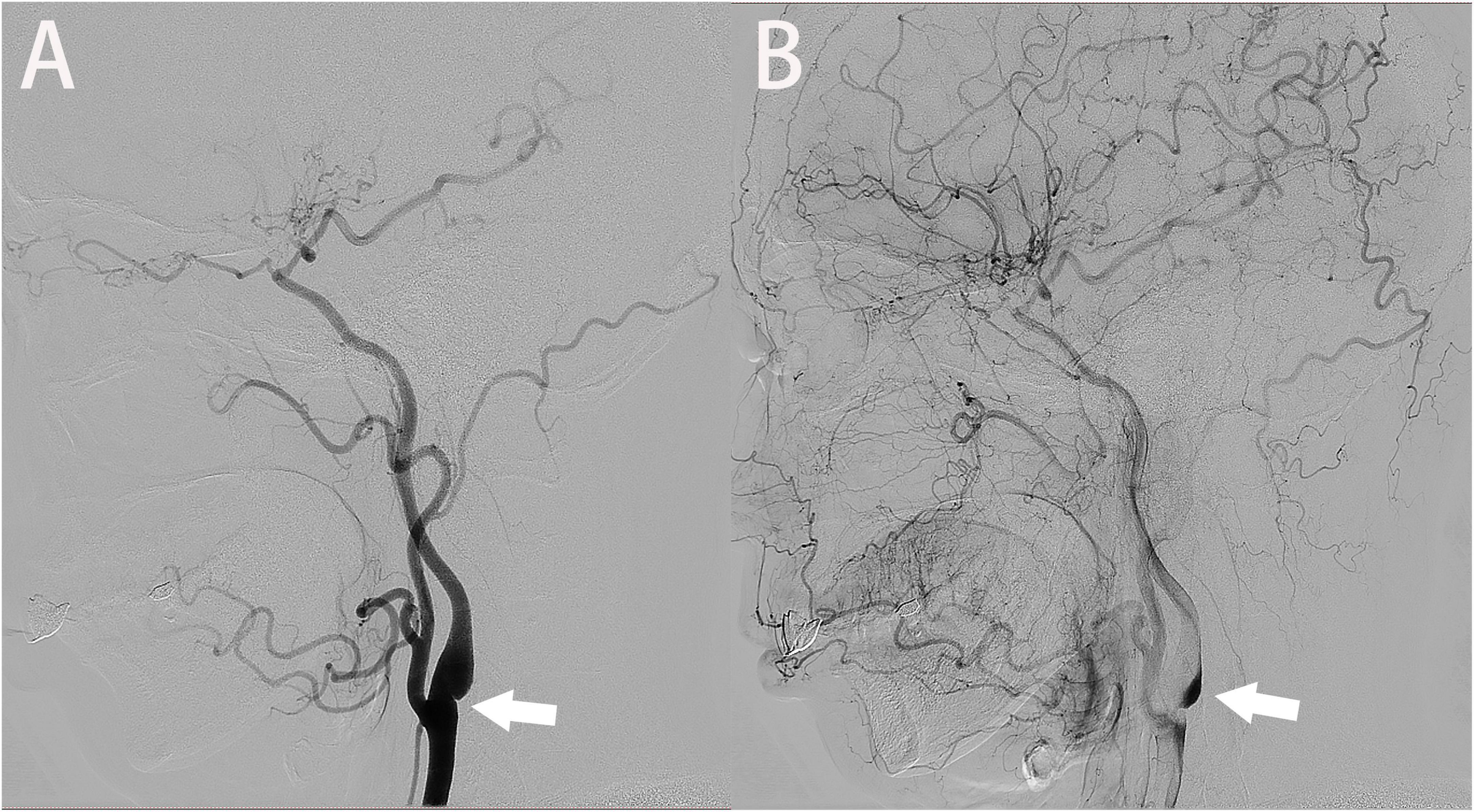 The carotid web: Current research status and imaging features